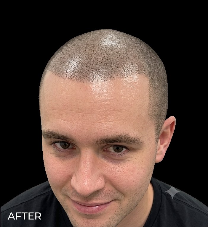 Male scalp after SMP — hairline restored healed result