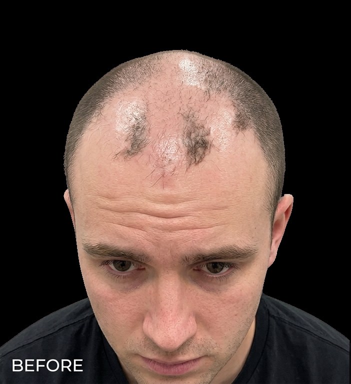 Male scalp before SMP — frontal hairline recession Norwood IV
